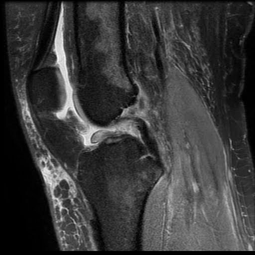 Radiology Cases: Subtle Wrisberg Rip (in setting of ACL tear)