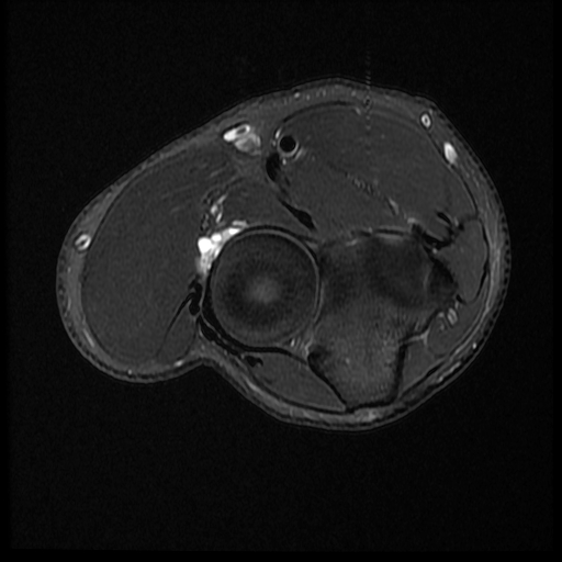 Radiology Cases PIN Syndrome (2)