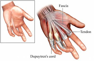 10501551 Dupuytrens Contracture