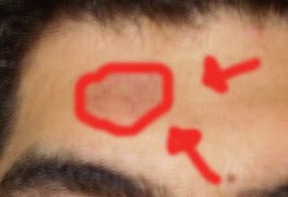 manchas rojas en la frente hombre