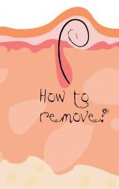 Jones Gallery Ingrown Hair Take Care Of This