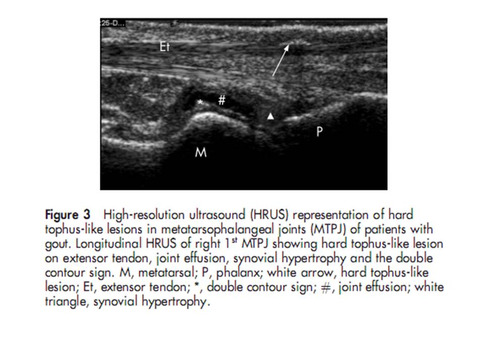 BÀI SOẠN VỀ SIÊU ÂM CHẨN ĐOÁN: HÌNH ẢNH SIÊU ÂM của GOUT/ULTRASOUND ...