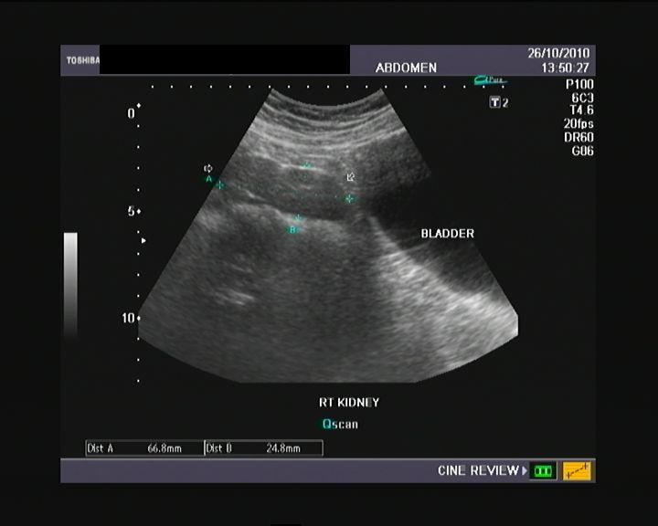 Ultrasound and Color Doppler videos: Pelvic kidney- ultrasound video study
