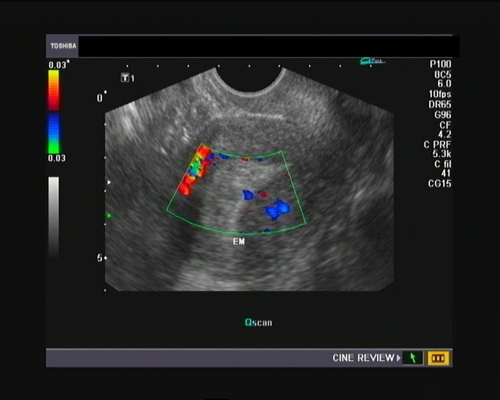 Ultrasound and Color Doppler videos Multiple