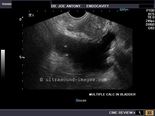 conclusion on ultrasound Ultrasound for detection of pneumothorax: sonographic lung sliding sounds so smooth, but how good is it for detection of pneumothorax. conclusion on ultrasound Ultrasound for detection of pneumothorax: sonographic lung sliding sounds so smooth, but how good is it for detection of pneumothorax.