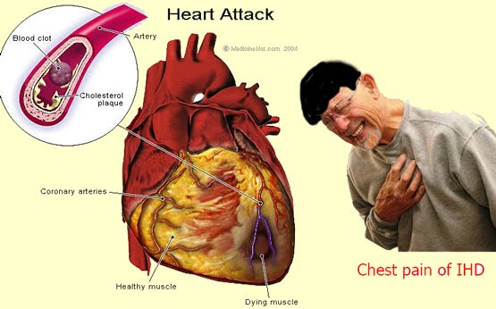 http://4.bp.blogspot.com/_DP4mgmsZ7NQ/TGPoUle4idI/AAAAAAAAA6M/uBTvhboLS-A/s1600/Heart+attack.jpg