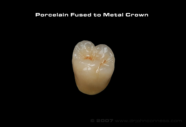 [porcelain metal.jpg]
