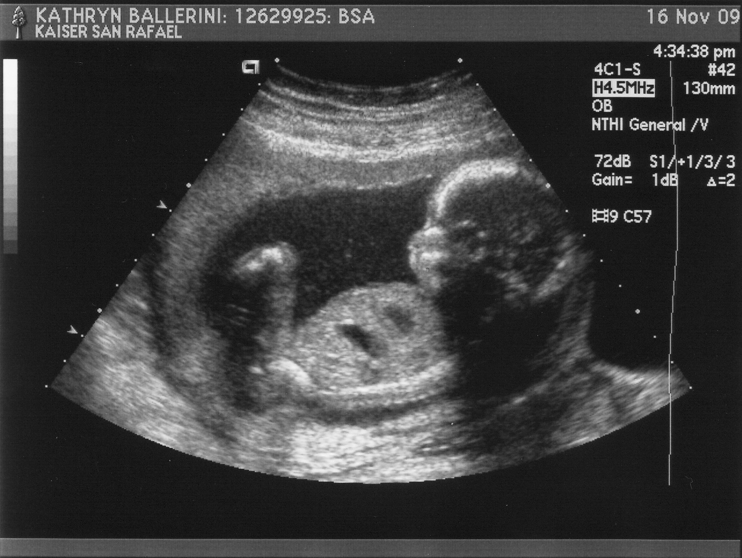9 недель беременности размер плода. УЗИ 10 недель беременности. 10 Недель как выглядит плод на УЗИ. Эмбрион на 10 неделе беременности УЗИ.