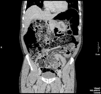 Organoaxialis sigma volvulus