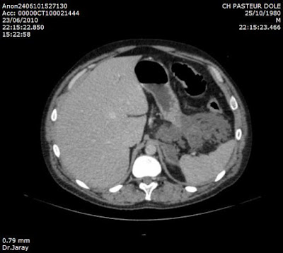 Acut pancreatitis (Balthazar E)