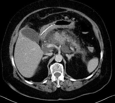 Centrális mirigy necrosis CT + UH I.