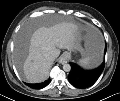 Cirrhosis talaján kialakult hepatocellularis carcinoma