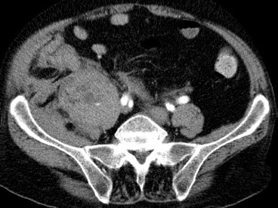 M. psoas maior bevérzése