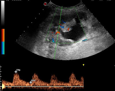 Transplantált vese üregrendszeri tágulata ureteritis következtében