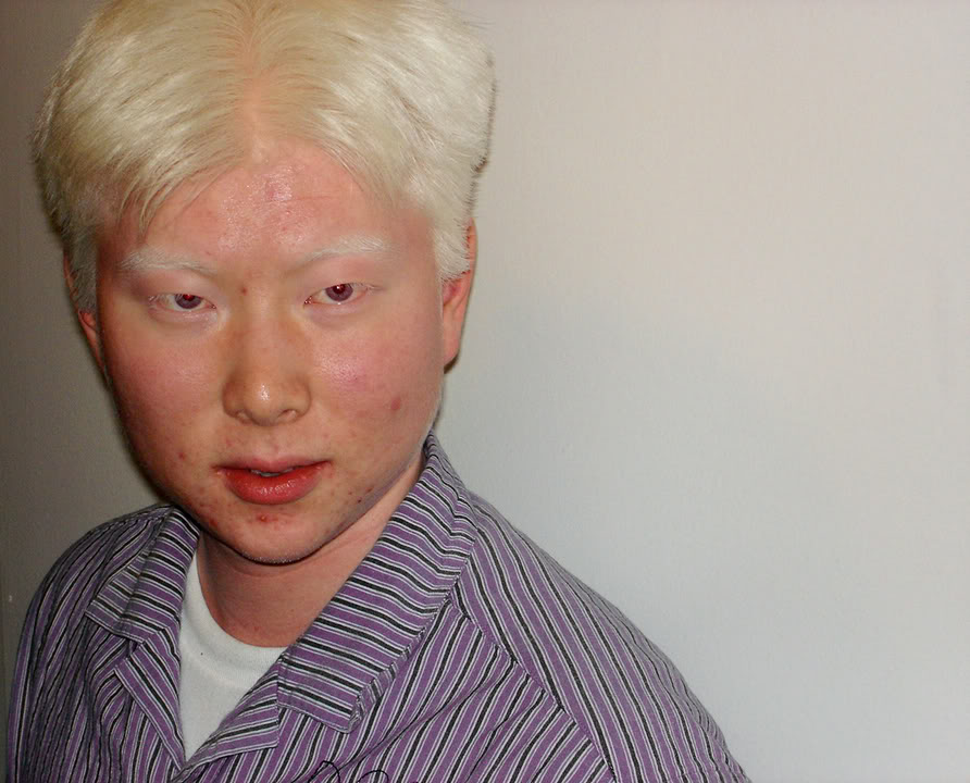 Albino Asian People 120