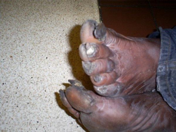 My Foot Transformation | Eliminate Crusty Feet | Baby Foot