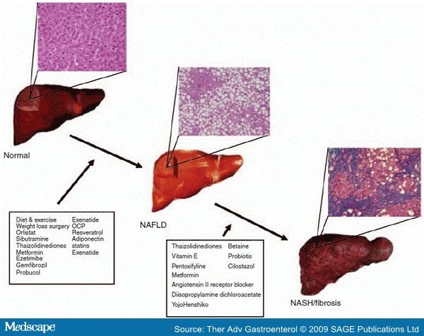 Natural Way To Treat Fatty Liver Disease Natural Way To Treat Fatty Liver Disease