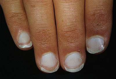 White Nail Beds On Fingernails