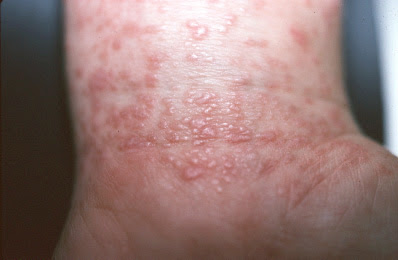Hives and Rash From Hep. C? - Hepatitis C - MedHelp