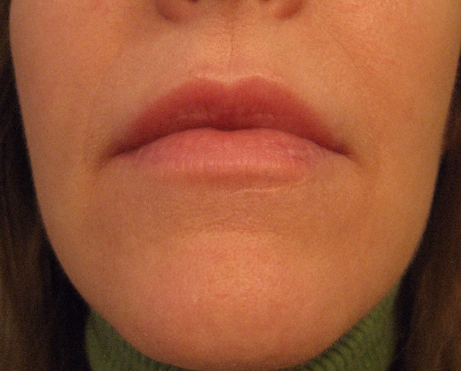 Chemical Peels for Acne and Anti Aging Above Lip Vertical Lines the