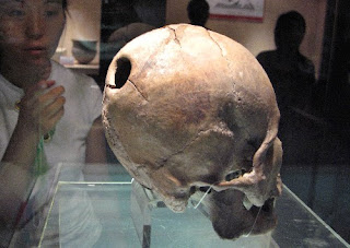 5,000 Years Ago Skull Surgery A Success