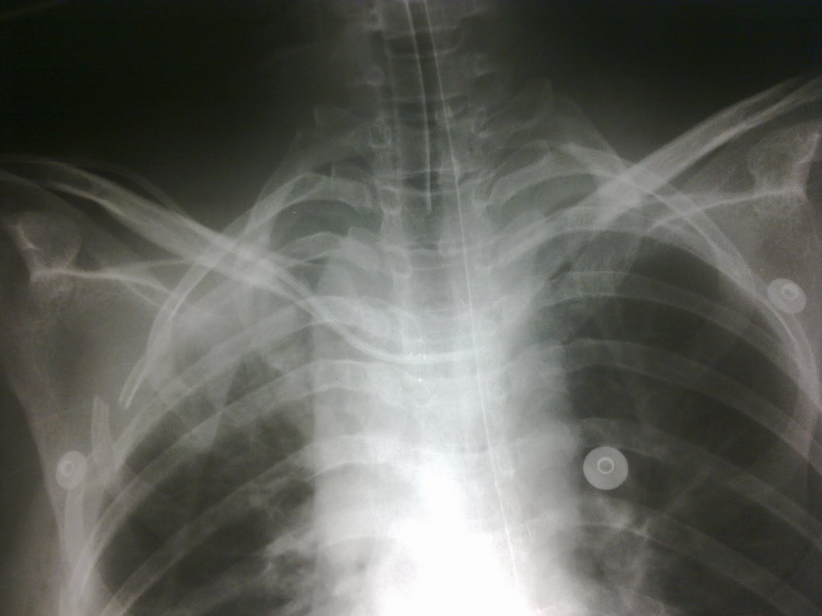 Central Venous Catheter X Ray