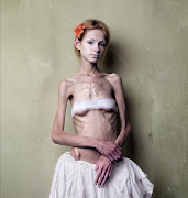 viernes, 30 de marzo de 2007 anorexia