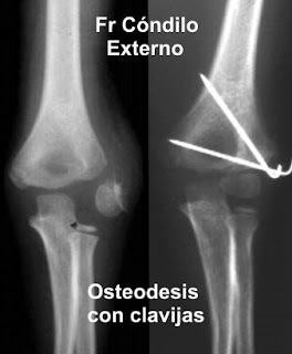 UNT PRACTICOS DE TRAUMATOLOGÍA: PRACTICO FRACTURAS DE CODO