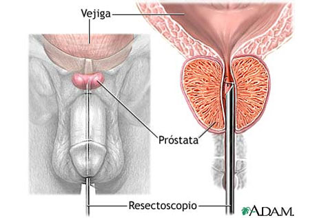 puntos de reflexología para problemas de próstata