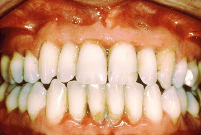 Gingivitis - Odontología ABC Blog de Ondontología