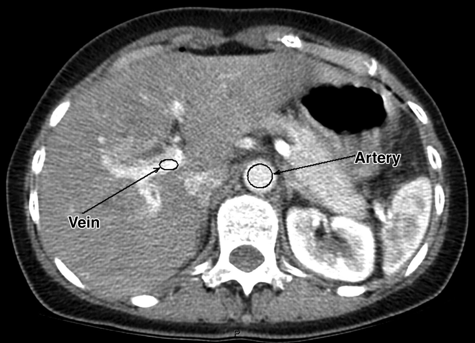 HCV Research and News Radiology Perfusion CT may aid in liver disease