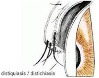 Distiachiasis EMERGENCIAS