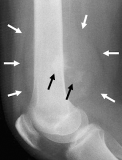 RadiologySpirit: Approach to bone lesions=figures and tables