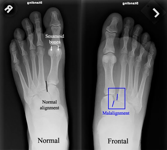 Lisfranc Fracture Types