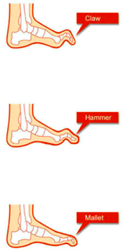 Central Florida Foot and Ankle Center - Sports and Running: Hammer ...