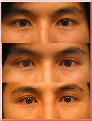 asian double lid upper eyelid surgery