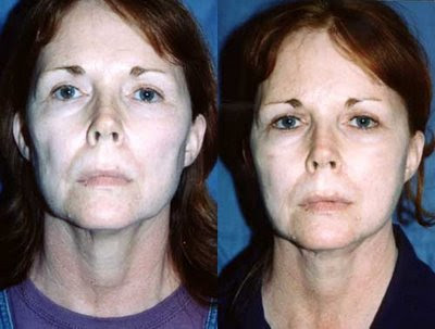 facelift with fat injection grafting