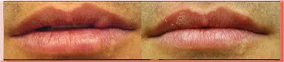 hypertrophic scar