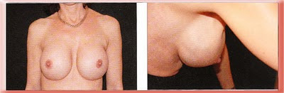 breast implant rippling