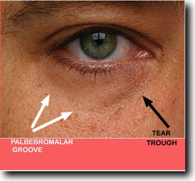 Nasojugal crease, tear trough deformity, nasojugal groove, bags under
