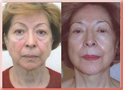 before and after lower blepharoplasty with fat repositioning