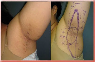 hidradenitis armpit