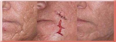 acne scar surgery
