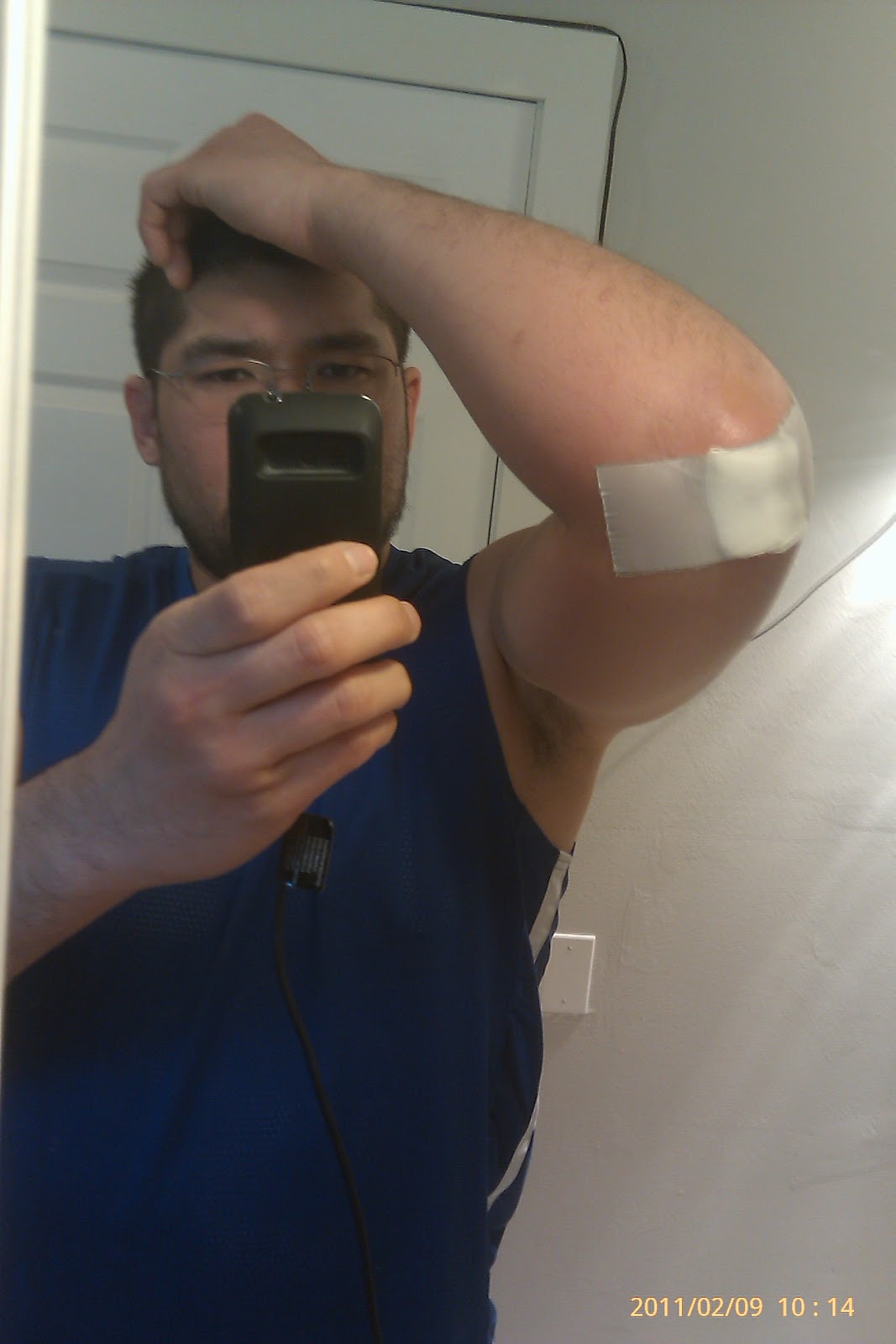 my life experience Seeming elbow sprain turns out to be Staph infection