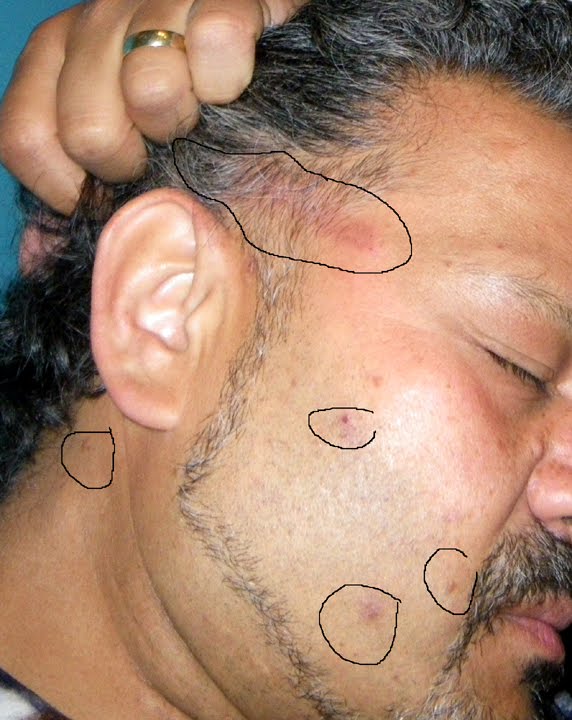 Dangerous Hair Dye A Serious Allergic Reaction To Ppd In A Serious Allergic Reaction To Ppd In Hair Dye