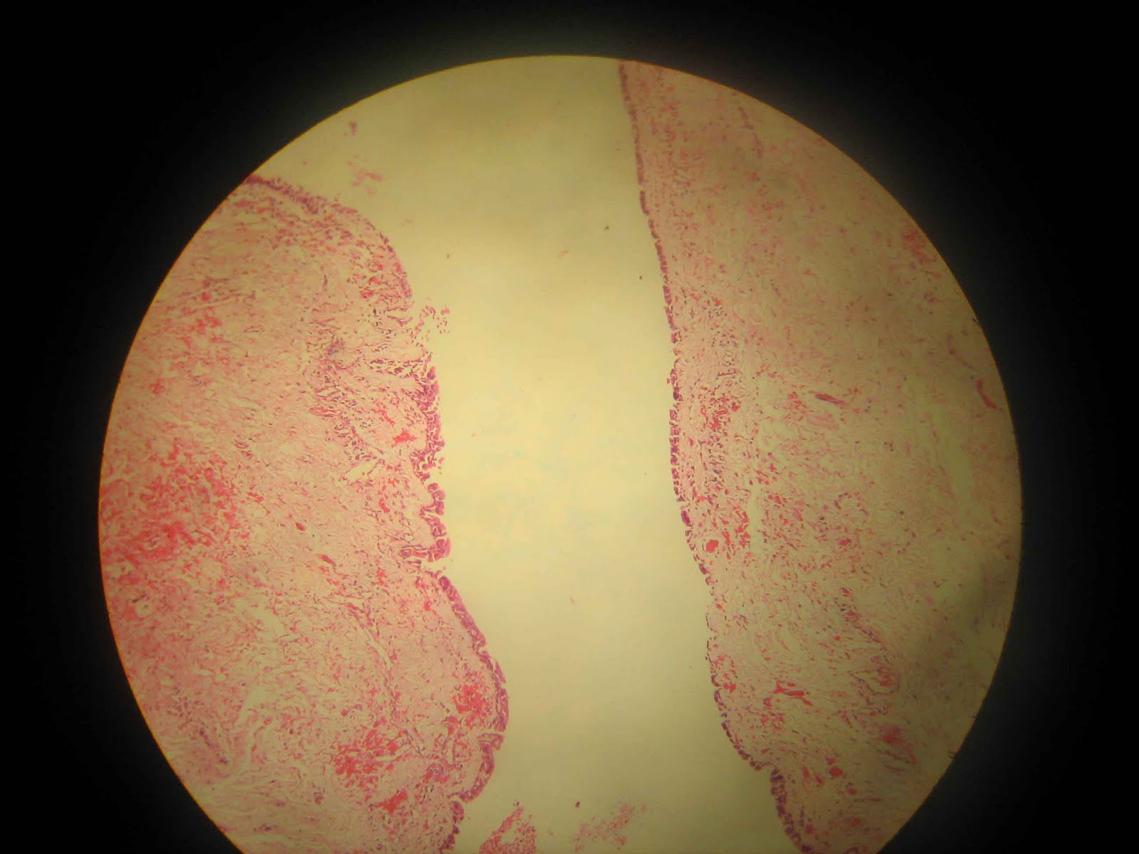 Dentistry and Medicine Naso labial cyst