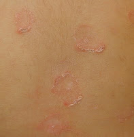 La psoriasis el tratamiento mitino