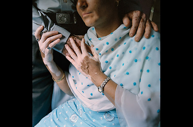 World Vitiligo Day - Ημέρα Λεύκης