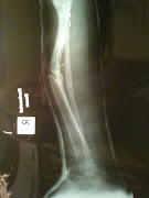 X-Ray taken Today 26.05.2010
