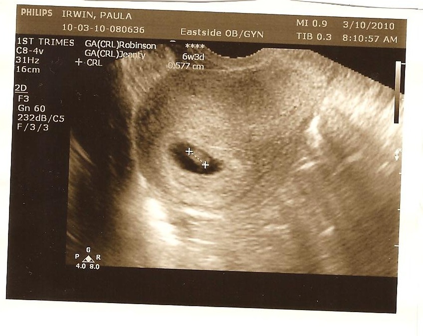 Weeks tilted uterus ultrasound 6 How Does
